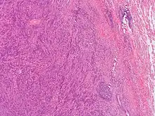 This image was originally posted to Flickr by Pulmonary Pathology at https://flickr.com/photos/30950973@N03/5601450952 (archive). It was reviewed on 3 October 2019 by FlickreviewR 2 and was confirmed to be licensed under the terms of the cc-by-sa-2.0.
