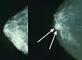 Mammograms showing a normal breast (left) and a breast with cancer (right)