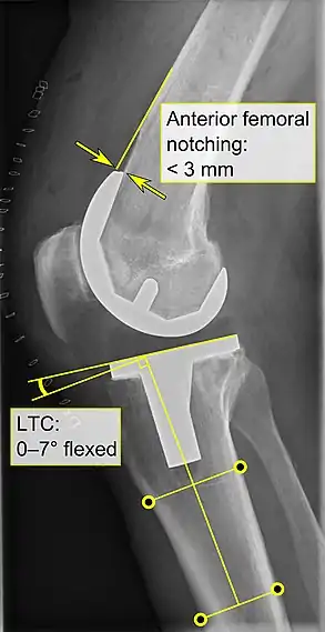 - Anterior femoral notching (the femoral component causing reduced thickness of the distal femur anteriorly), seems to cause an increased risk of fractures when exceeding about 3&nbsp;mm.- LTC: lateral (or sagittal) tibial component angle, which is ideally positioned so that the tibia is 0–7° flexed compared to at a right angle with the tibial plate.