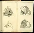 De l'auscultation médiate&nbsp;... Most of the plates in his book illustrate the diseased lung as do these four images that are consistent with lungs affected by tuberculosis.