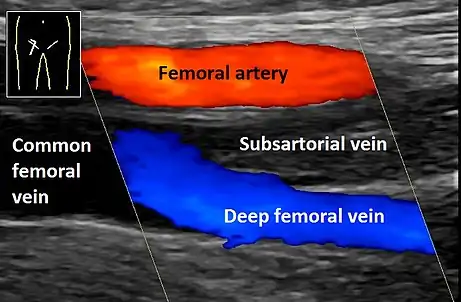 Doppler ultrasonography showing absence of flow and hyperechogenic content in a clotted femoral vein (labeled subsartorial) distal to the branching point of the deep femoral vein.  When compared to this clot, clots that instead obstruct the common femoral vein (proximal to this branching point) cause more severe effects due to impacting a significantly larger portion of the leg.